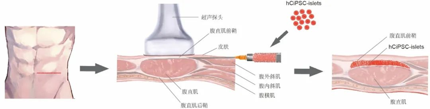 胰島細(xì)胞腹直肌前鞘下移植的示意圖
