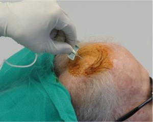 干細(xì)胞注射到大腦過(guò)程。